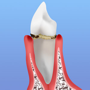 歯ぐきをしっかり～歯周病のチェック～