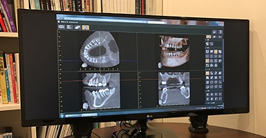 歯科用CT