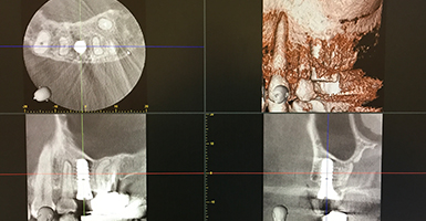 歯科用CT