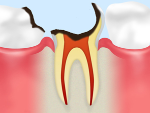 C3：神経にまで達した虫歯
