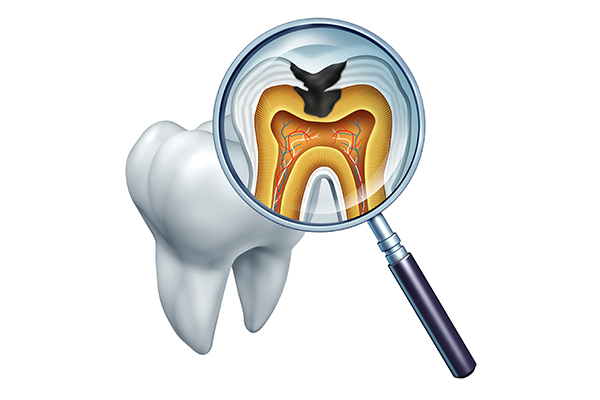 重度の虫歯には根管治療を行います