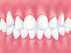 八重歯：叢生（そうせい）の一種