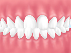 歯がずれている：交叉咬合