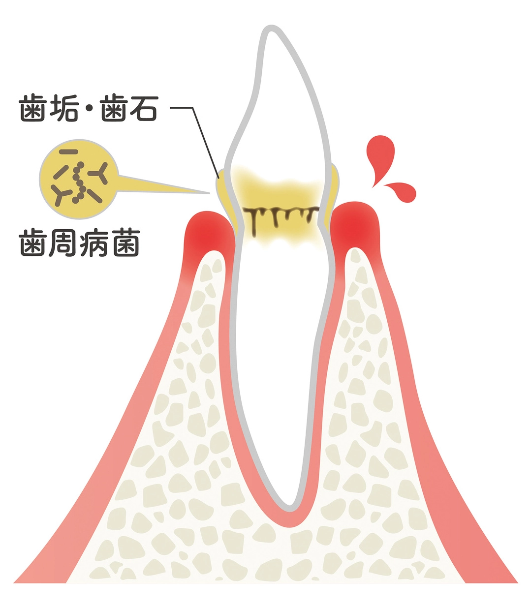 初期の歯周病